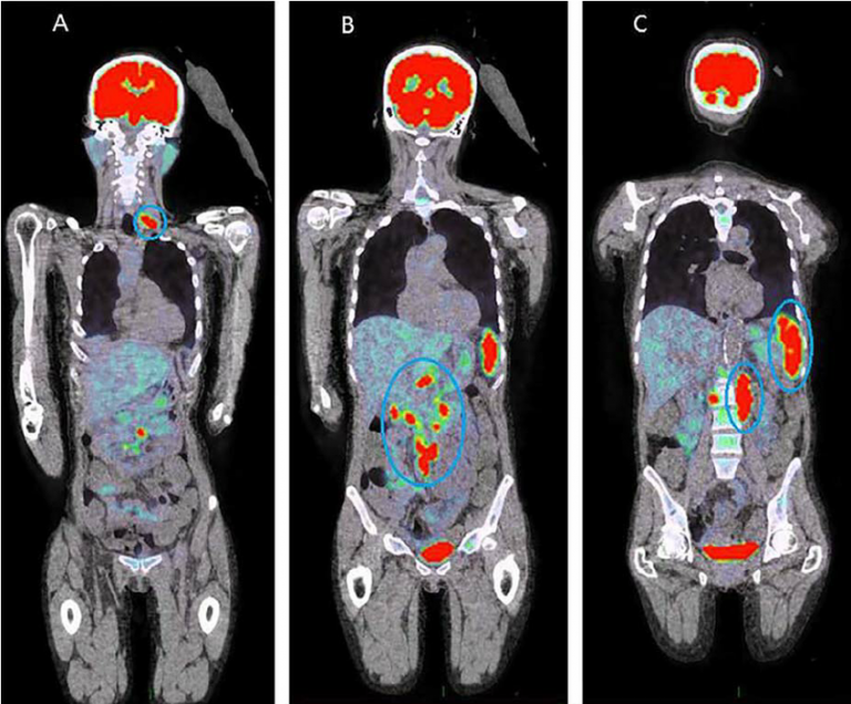 An Overview About PET CT Scans In A Nutshell PrzeSpider