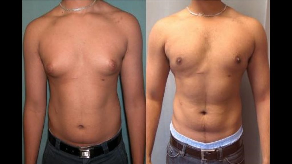 Average Cost Of Gynecomastia Surgery In India PrzeSpider